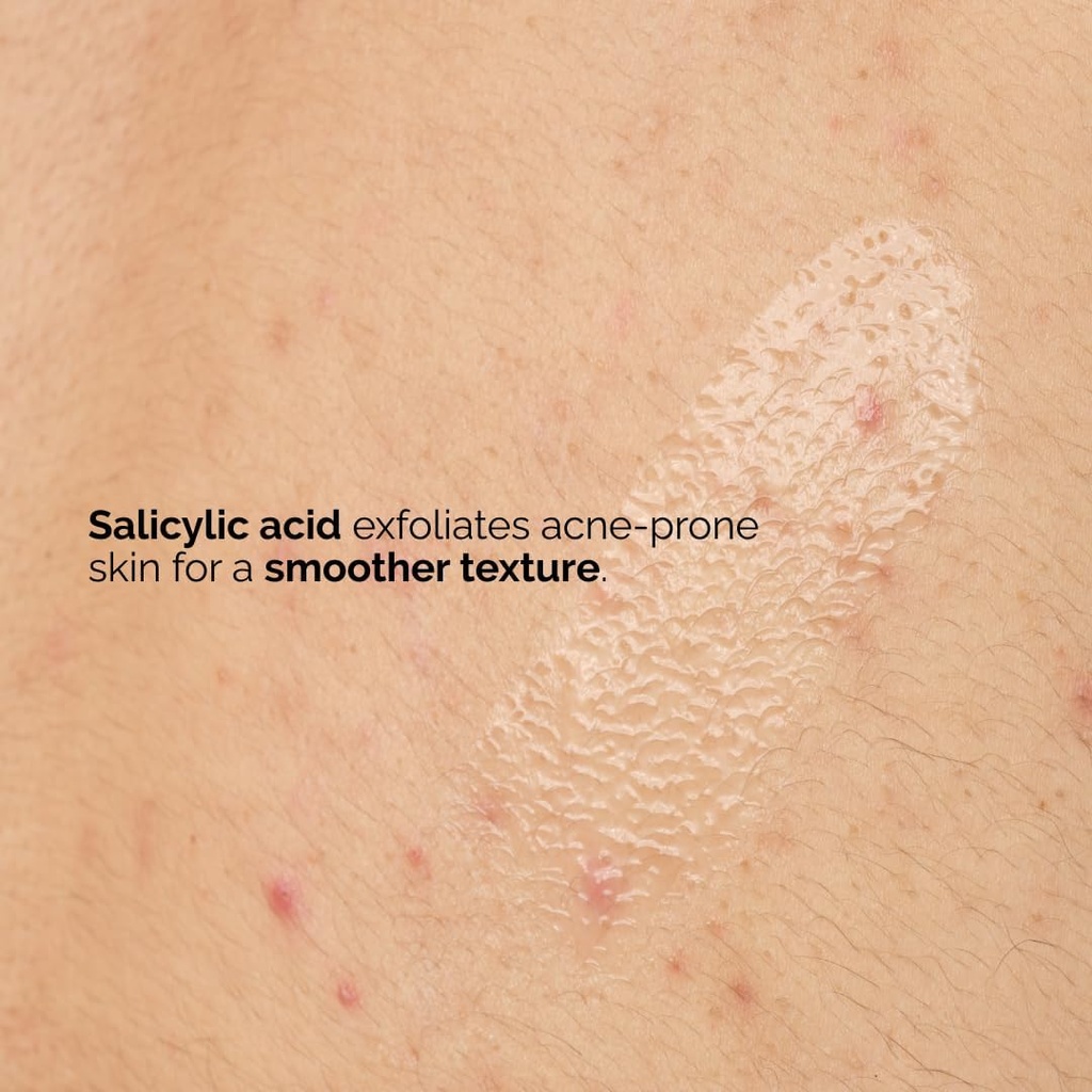 The Ordinary Salicylic Acid 0.5% Body Serum, Exfoliating Treatment for Acne-Prone Skin, 8.1 Fl Oz Brand.